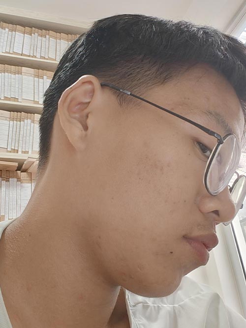 Closed Comedones Treatment Liquid